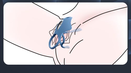 【CockRing】Men Cock Ring Women G Spot Stimulator App Remote Control - Lunarlulu